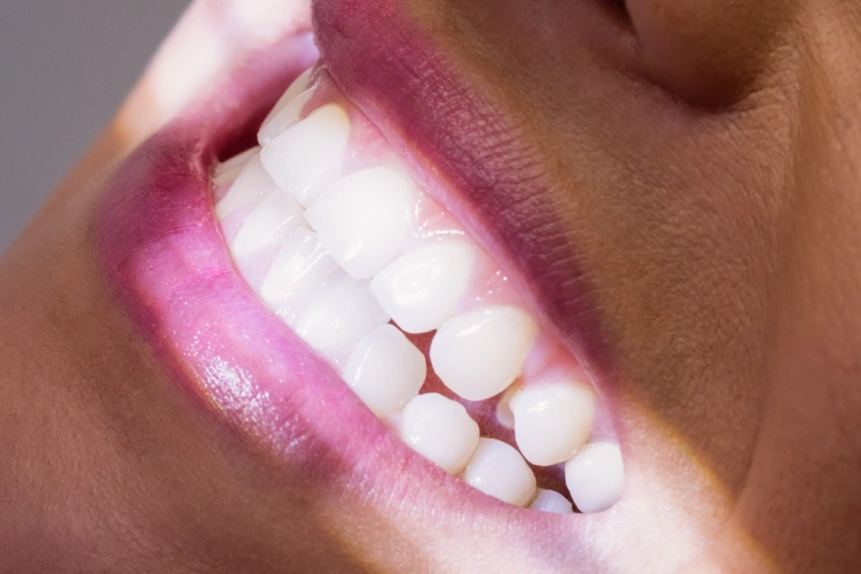 Carillas Estéticas - Nexus Dental Lab Málaga