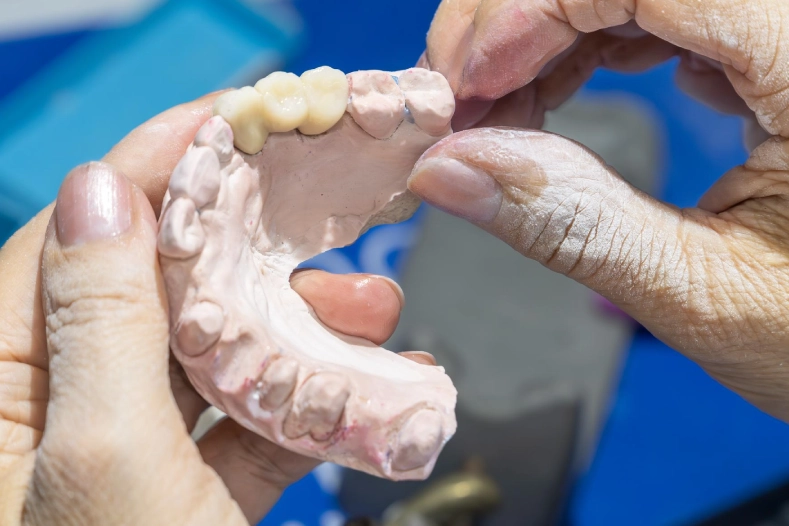 Prótesis Fijas - Nexus Dental Lab